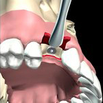Pose de la vis de cicatrisation au cours d'un deuxième temps opératoire ( de 3 à 6 mois après la pose de l'implant )