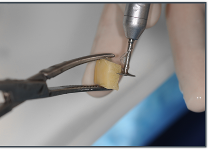 Greffon osseux hétérigène - Implant Dentaire - Implantologie