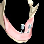 Fixation d'une prothèse compléte amovible sur 2 attachements implanto-portés